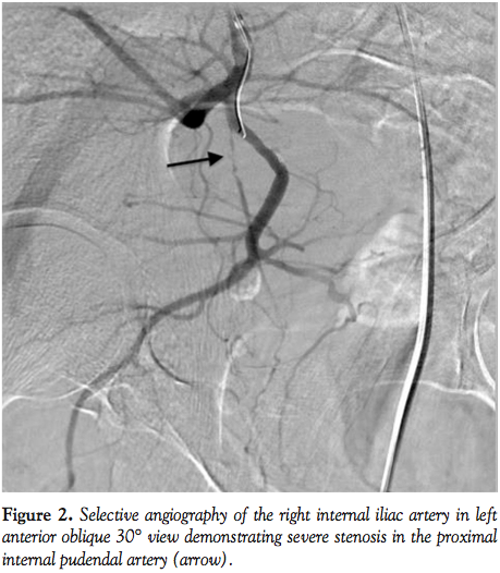 Angiography And Endovascular Revascularization Of Pudendal Artery angiography-and-endovascular-revascularization-of-pudendal-artery